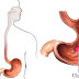 Peptic Ulcer definition, causes and pathogenesis Peptic Ulcer definition, causes and pathogenesis