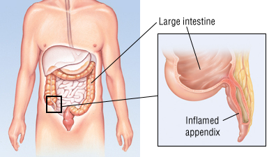 what happens when the appendix bursts what happens when the appendix bursts