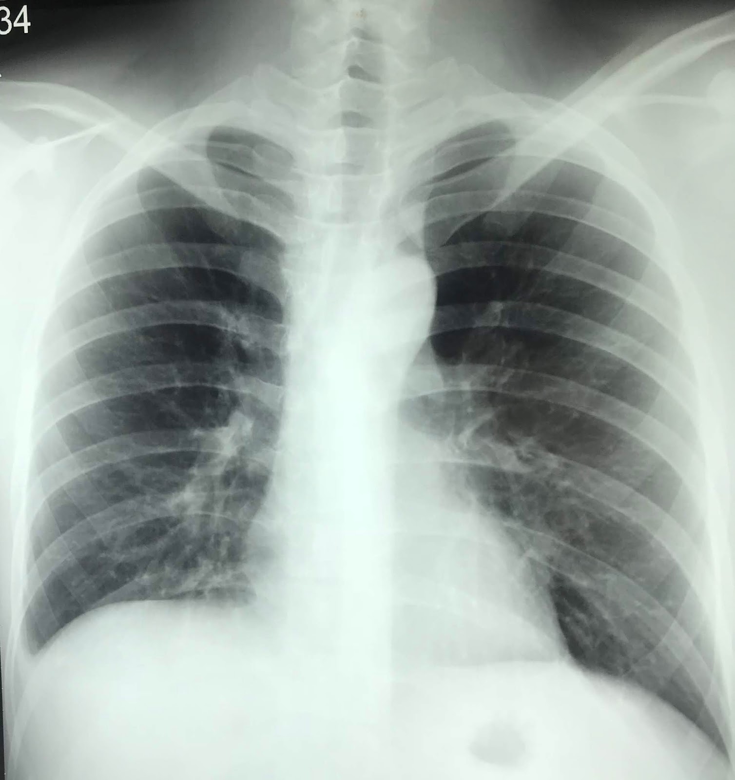 VIETNAMESE MEDIC ULTRASOUND CASE 539 DENGUE FEVER and ASCITES, Dr