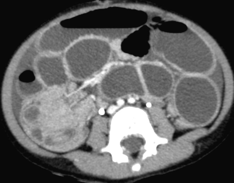 Left Abdominal Pain January 2015