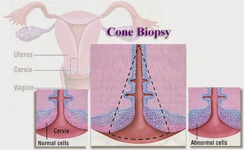 Conization Definition Medical Treatment Pictures-for Better Understanding: Cervix Conization ...
