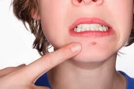 Pele com Tendência a acne - Como cuidar?