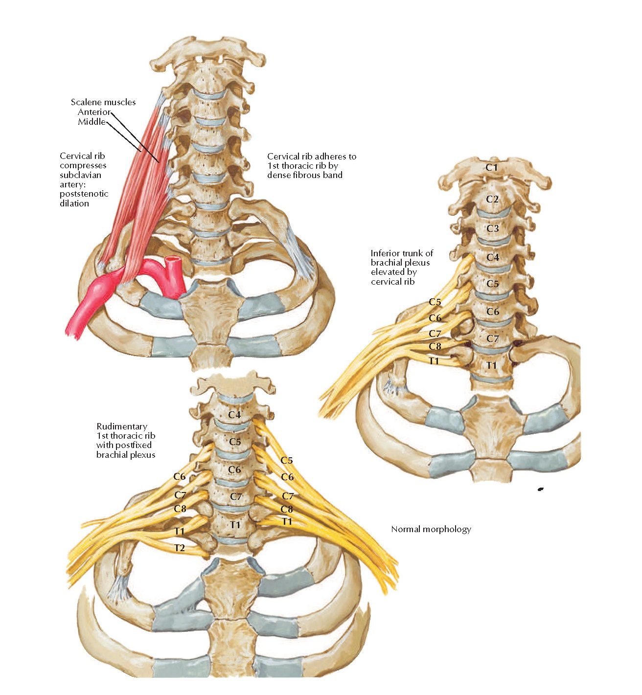 Cervical Ribs and Related Anomalies Anatomy pediagenosis