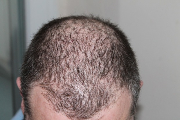 Penyebab Rambut Rontok pada Pria Penyebab Rambut Rontok pada Pria