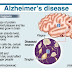 Does Alzhiemers Cause Mood Swings