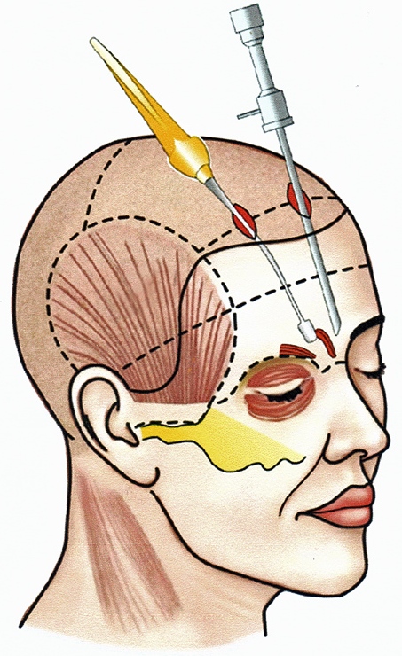 височная эндоскопическая подтяжка. смас лифтинг средней зоны лица после операции. лобно височная эндоскопическая подтяжка. лобно височная операция. эндоскопический лифтинг средней зоны лица.