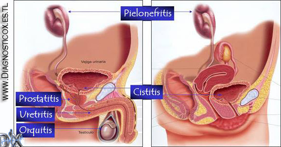 es la prostatitis a uti