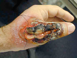 bite centipede spider bites brown recluse millipede millipedes spiders symptoms camel wound hand widow poisonous skin centipedes wolf human water