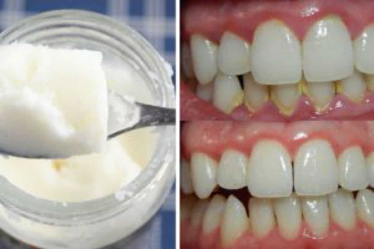 Say Goodbye To Dental Plaque And Bad Breath With A Single Ingredient!