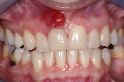 Nguyên nhân viêm chân răng là gì?