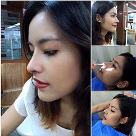 Your Cosmetic Surgery Guides In Thailand The Best Nose Augmentation In Thailand