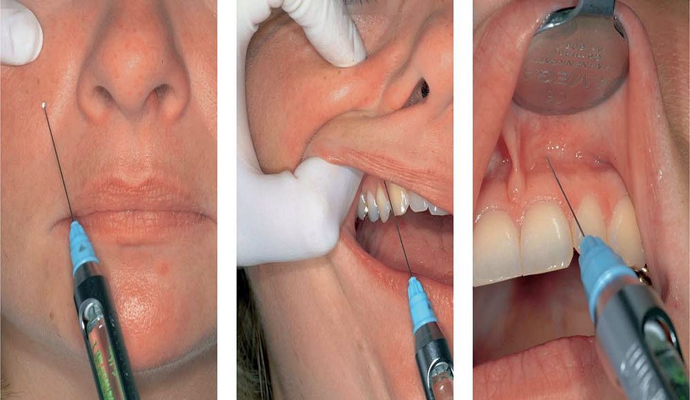 Dental Anesthesia