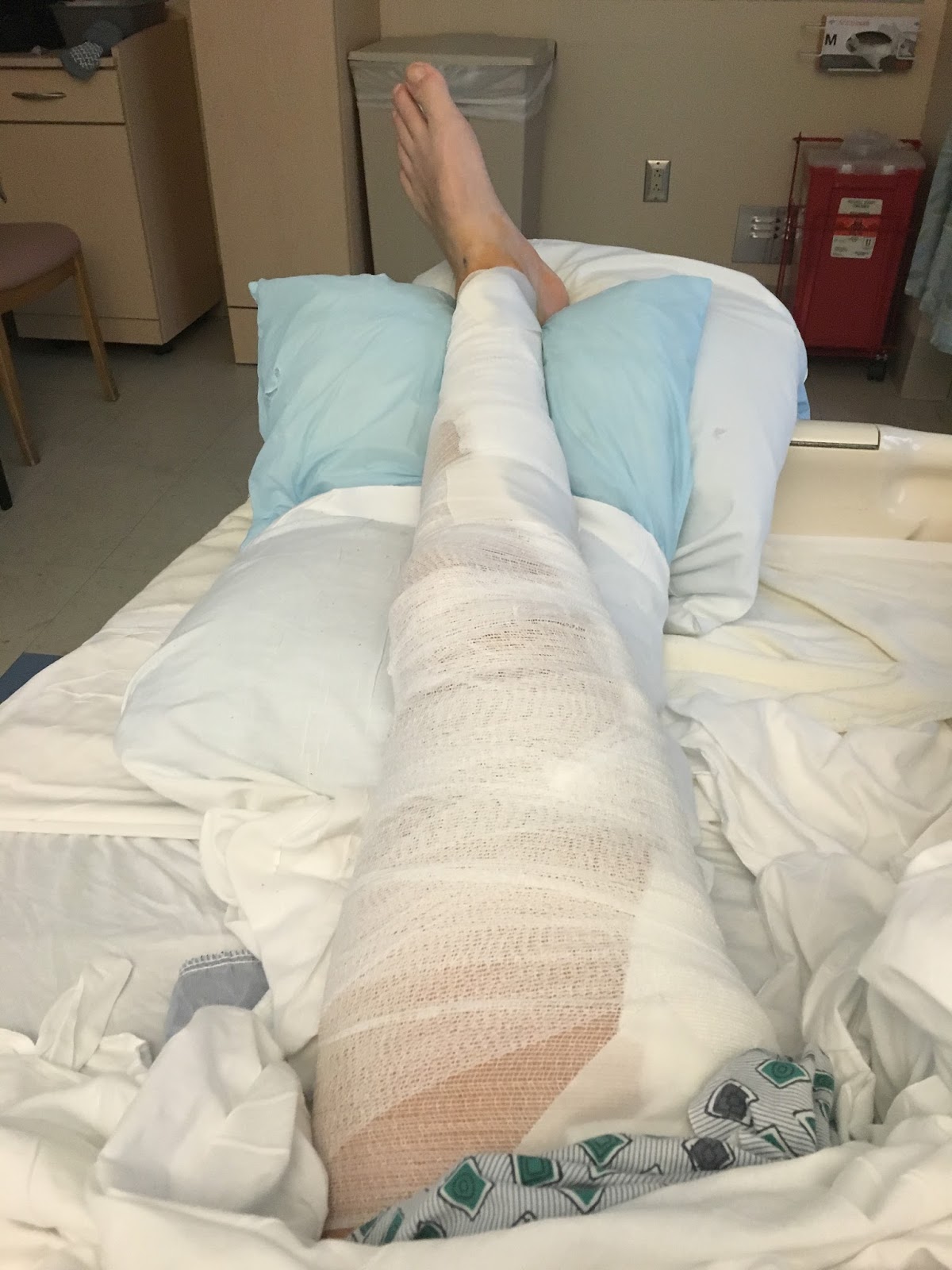 Femoral Popliteal Bypass My Recovery Timeline from FemPop Surgery