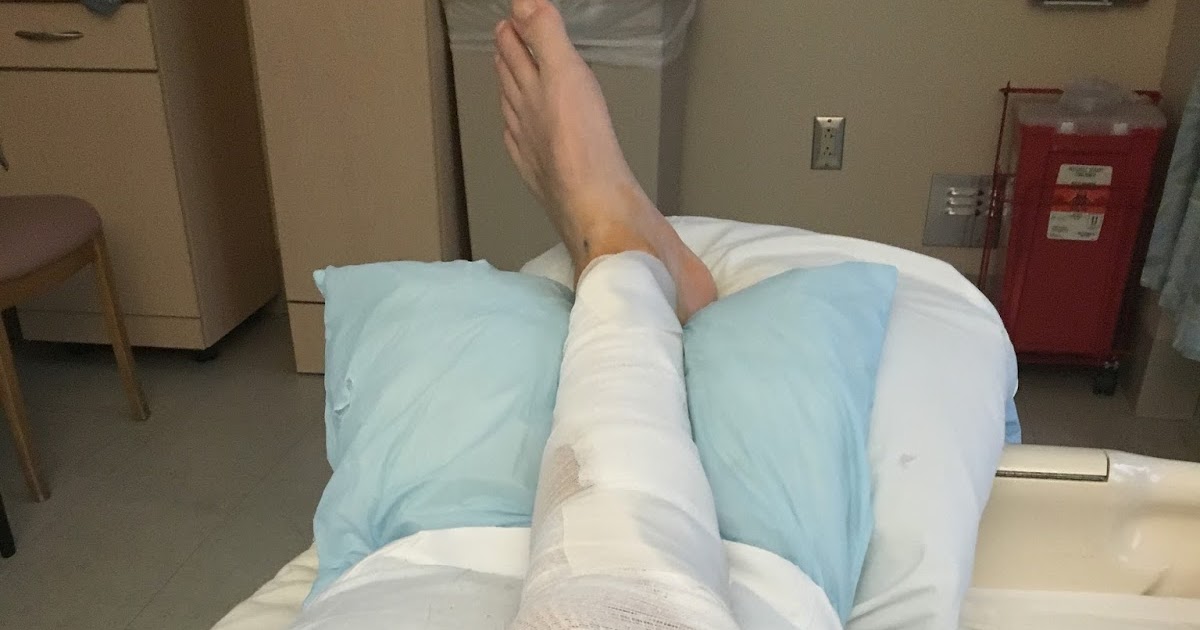 Femoral Popliteal Bypass My Recovery Timeline from FemPop Surgery