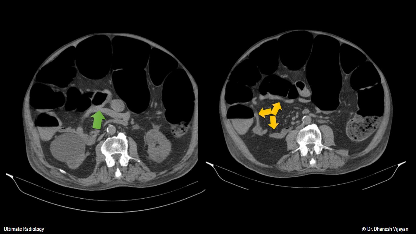 Ultimate Radiology Ogilvie Syndrome or Acute Colonic Pseudo Obstruction