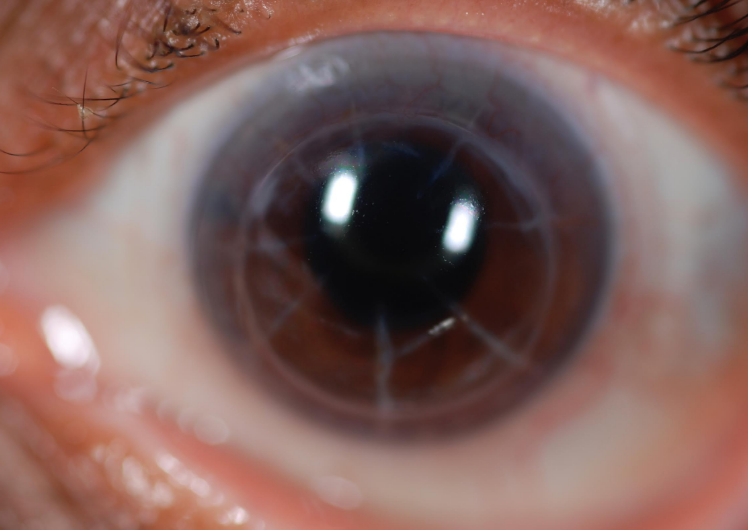Corneal Tattooing Can Cheer Up Blind Eye Patients