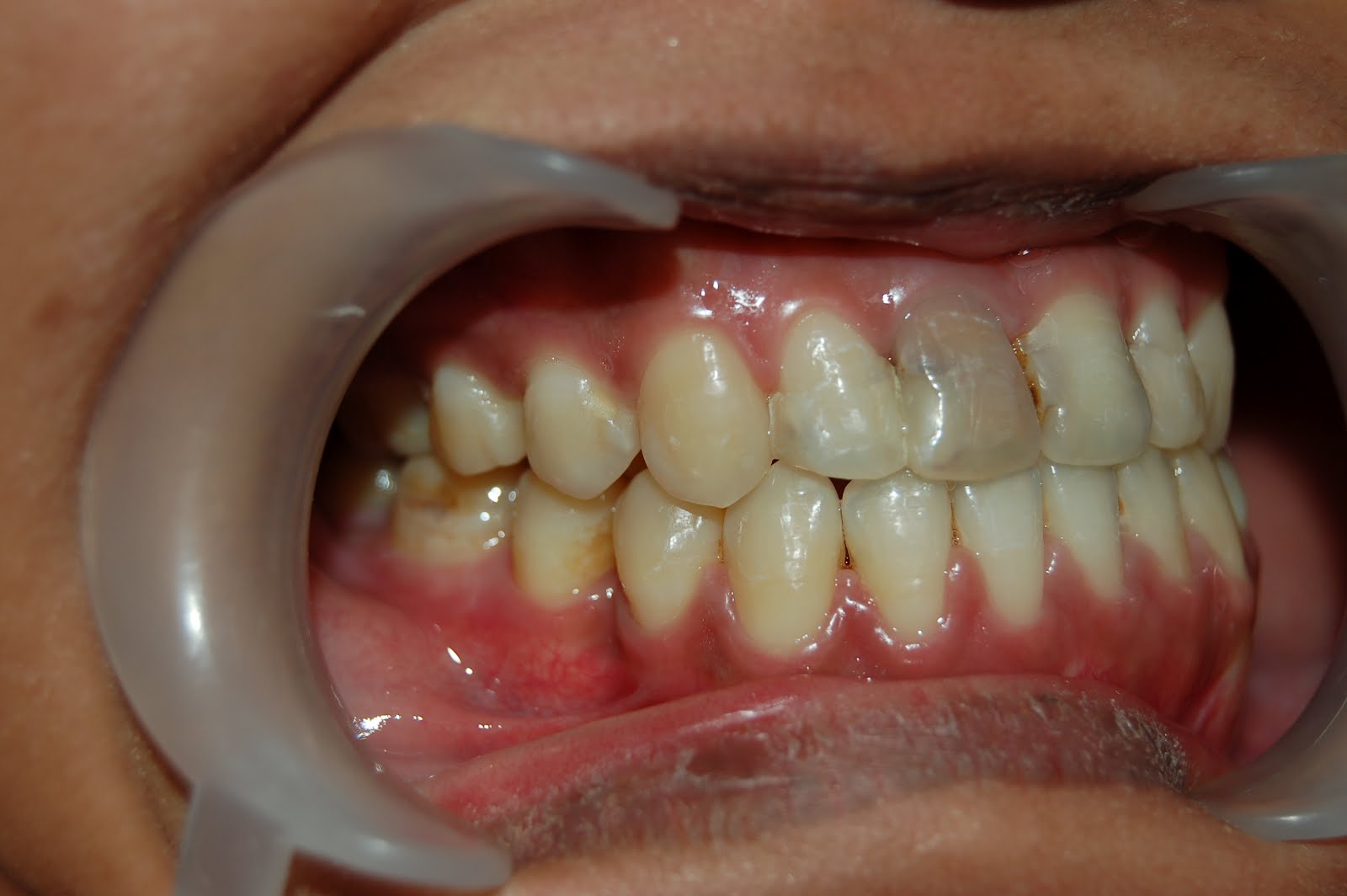 Aryabrahmanta: orthodontic camouflage treatment of skeletal class iii