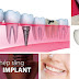 Quy trình bọc răng sứ Implant chỉ cần 2 lần hẹn
