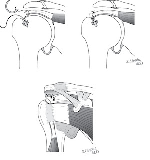 UW Shoulder and Elbow Academy: Rotator Cuff 13 - Full thickness rotator ...