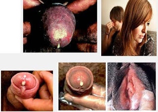 Nama Obat Gonore (Kencing Nanah) Di Apotek, penyakit gonorrhea gono, tanda kencing nanah mau sembuh, obat sipilis tanya dokter, obat pembunuh bakteri gonore (kemaluan keluar nanah), infeksi sipilis