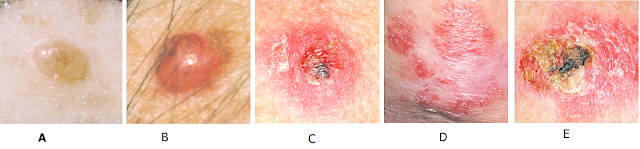  Common symptoms of basal cell 