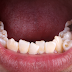 Các phương pháp niềng răng mọc lệch hiệu quả