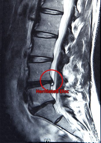 herniated disk xray herniated disk xray