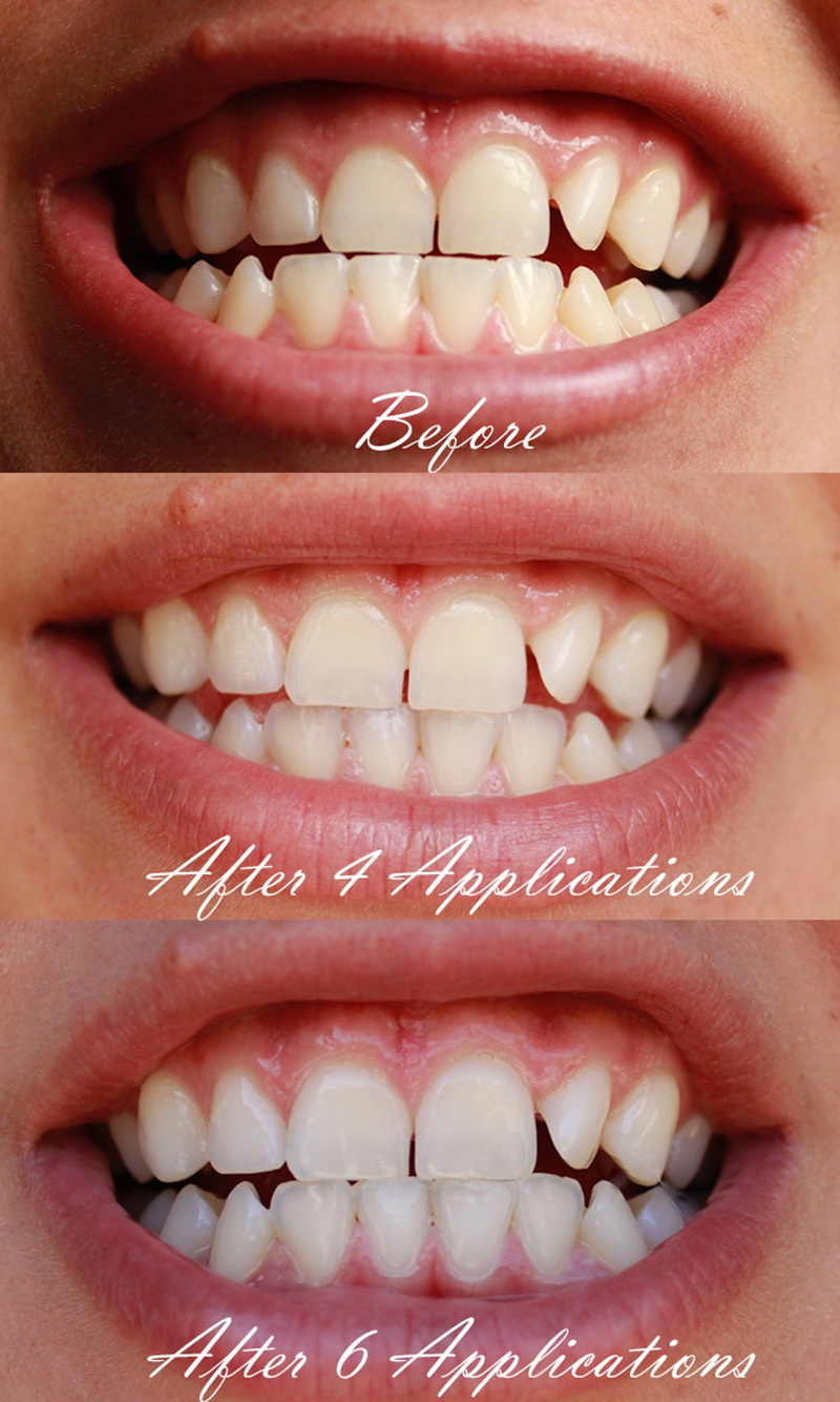 GIVEAWAY: How to Enhance Your Smile with Smile Brilliant ...