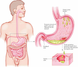 Obat Maag Dan Lambung