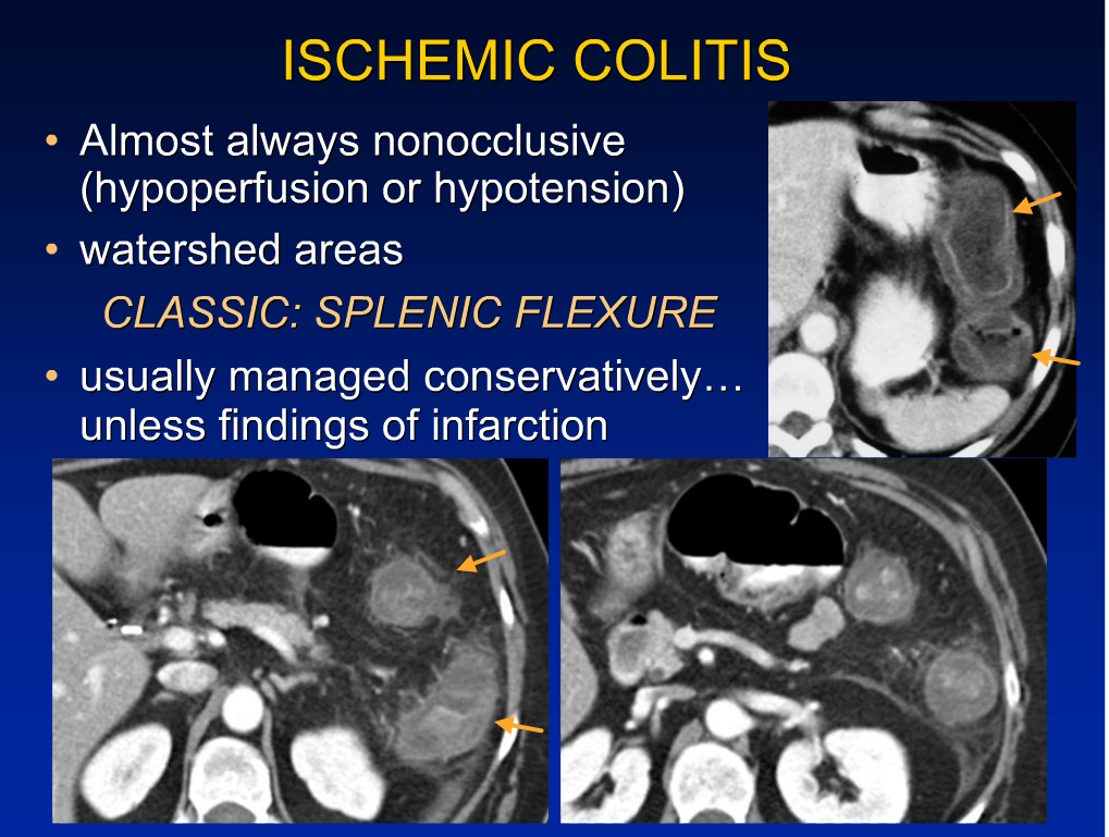 rsna ischemic bowel disease 완전 정리 짱