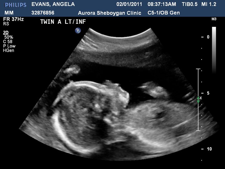 The Evans Twins 21 Week Ultrasound Pics Twin A Is The Girl And Twin the-evans-twins-21-week-ultrasound-pics-twin-a-is-the-girl-and-twin