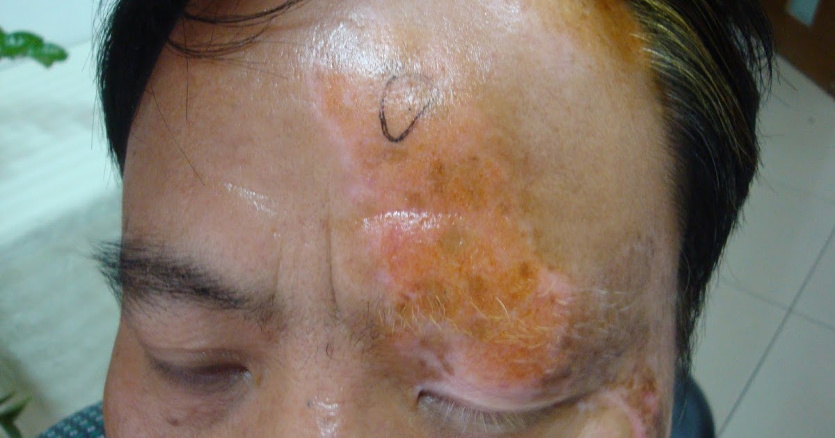 Chines Medicine Treatment for Vitiligo