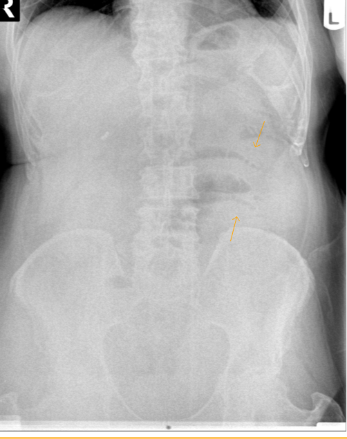String of Beads SignSmall Bowel Obstruction Sumer's Radiology Blog