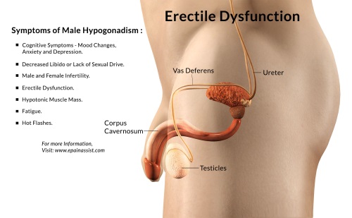 Signs and symptoms of erectile dysfunction