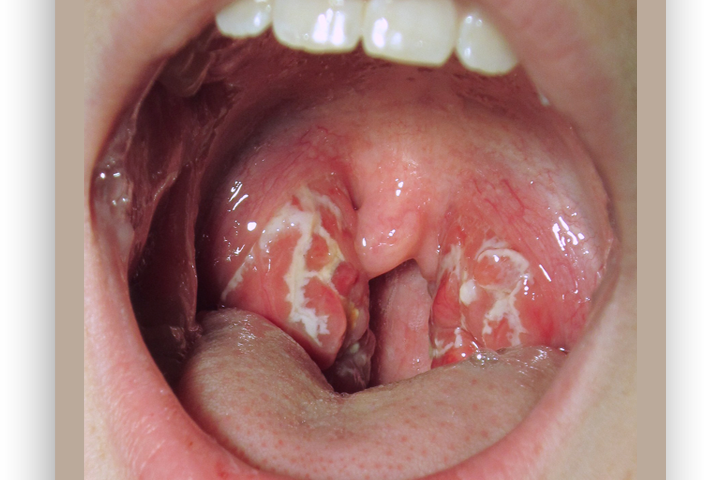 strep throat pics adults