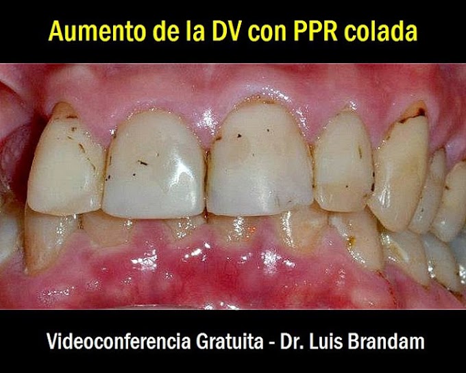 VIDEOCONFERENCIA: Aumento de la Dimensión Vertical con PPR colada -  Dr. Luis Brandam