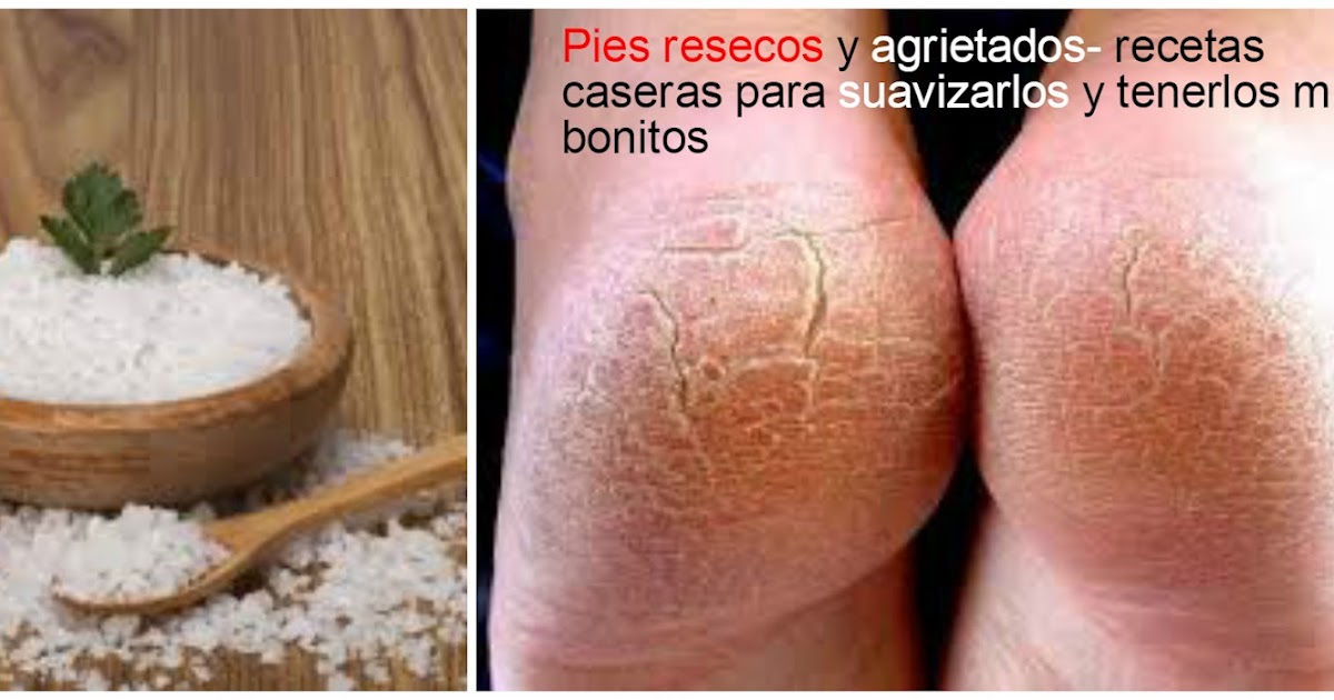 tratamiento para los pies resecos y agrietados