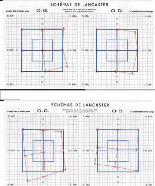 Test de Hess Lancaster