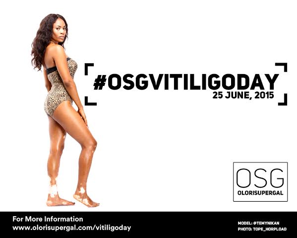 It's World Vitiligo day,an event for awareness of the Skin Condition. ty