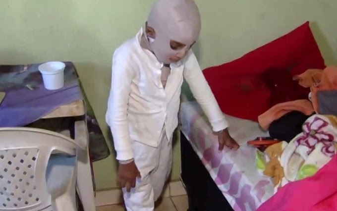 Menino tem corpo queimado em brincadeira em GO