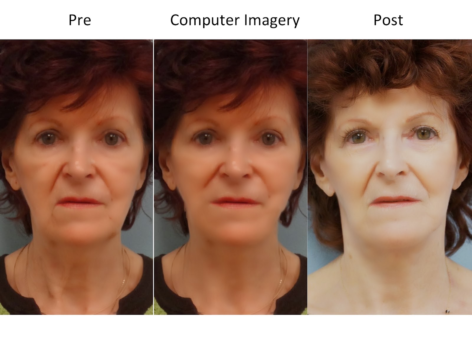 Facial Plastic Surgery Facelift, Necklift, Platysmaplasty, ERBYAG