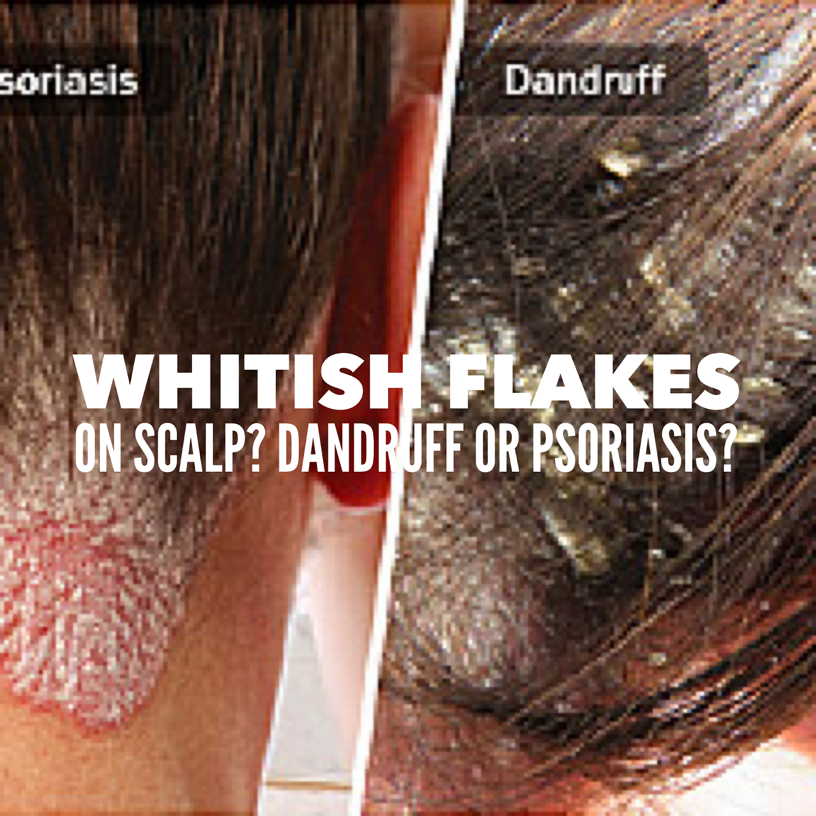 SoapLab Malaysia: Flaky White Thing On Your Hair: Is it Psoriasis Or  Dandruff?