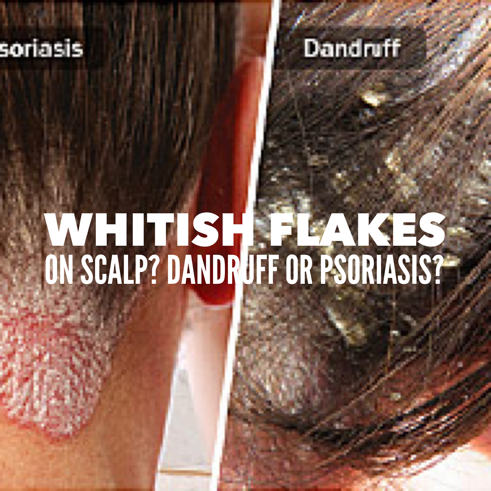 SoapLab Malaysia Flaky White Thing On Your Hair Is it Psoriasis Or