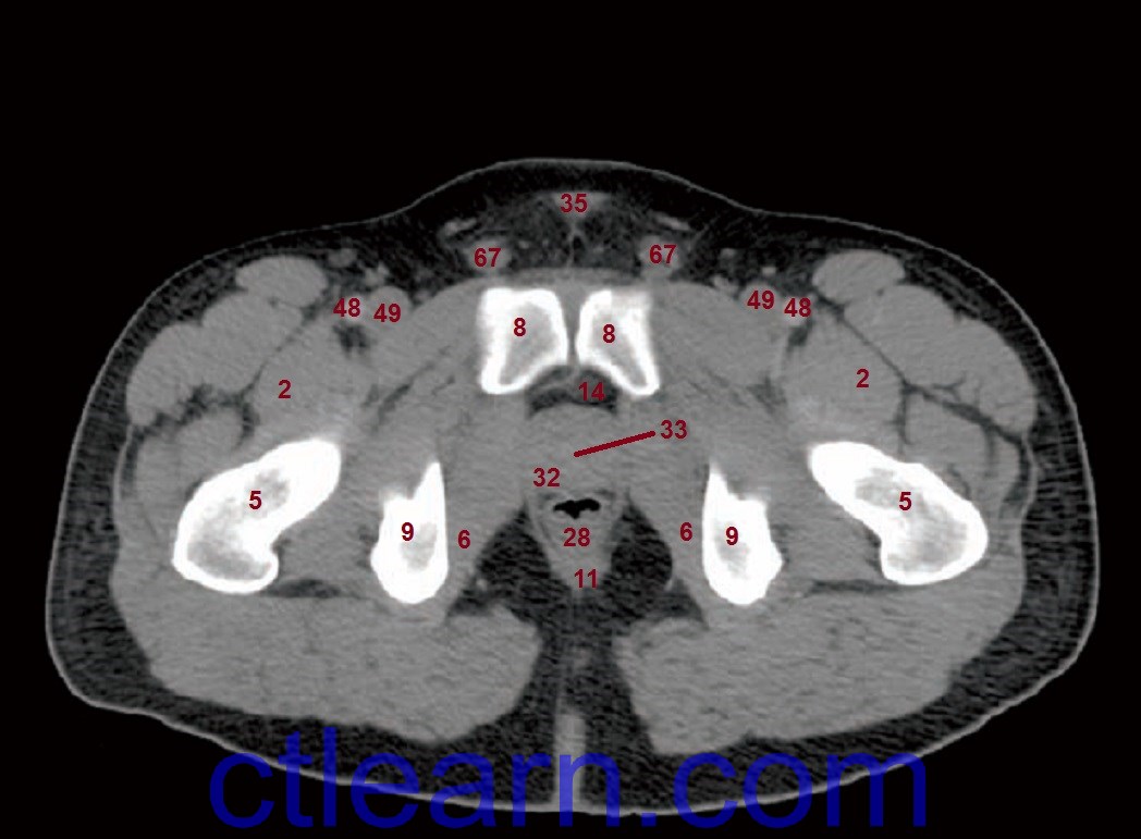 Ct Anatomy Pelvis Muscles Presentation1pptx Ct Normal Anatomy Of