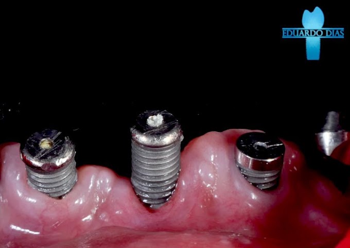 IMPLANTODONTIA: Remoção de implantes e novos implantes para protocolo