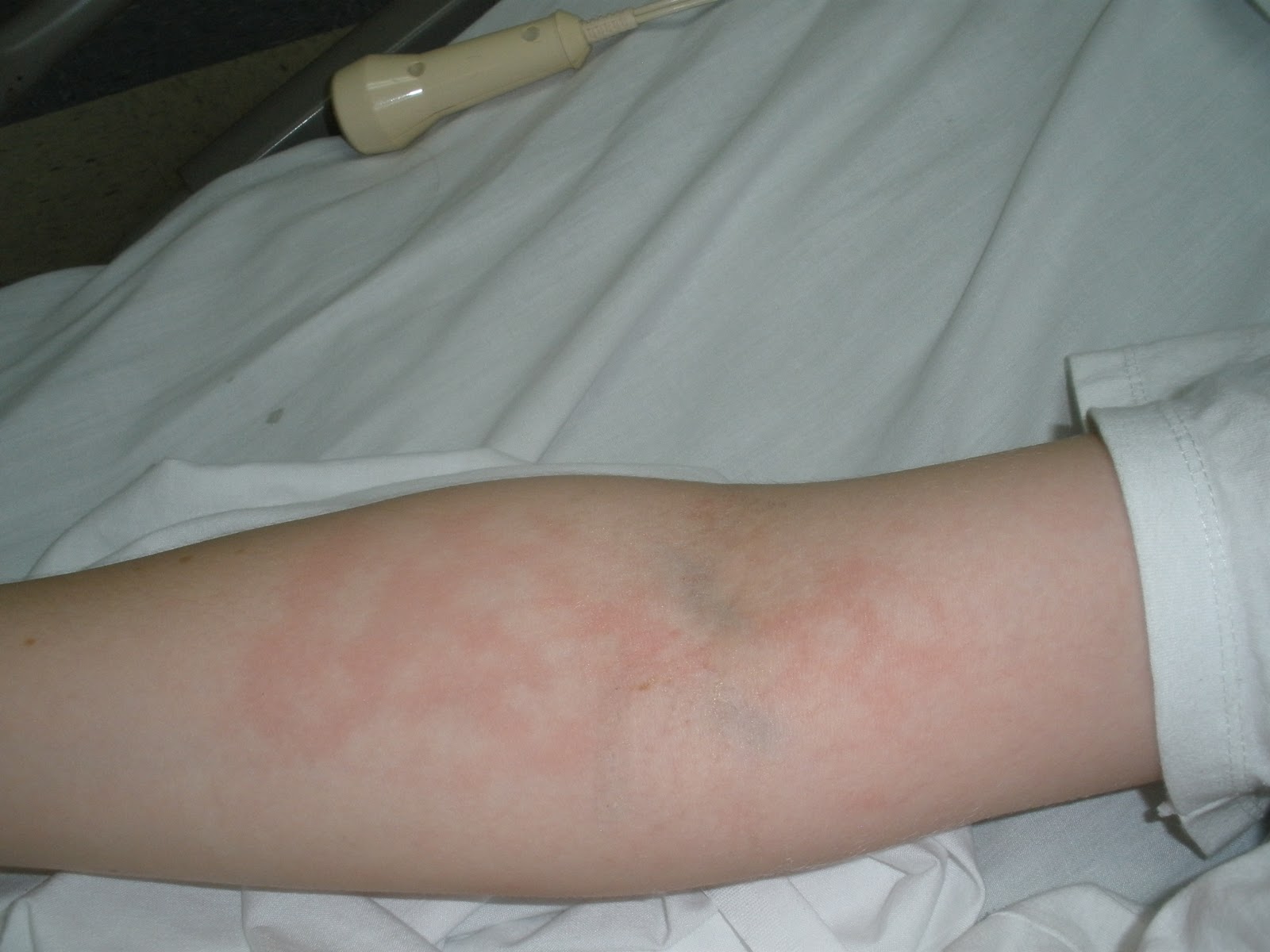 chicken pox rash images #11