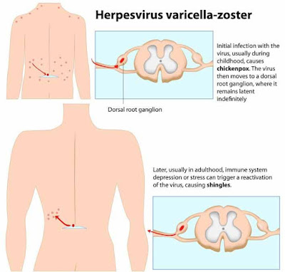 ¿Qué es el Herpes Zóster?