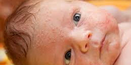 Baby acne causes and treatment