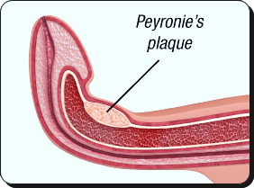 Obat Peyronie Tradisional Utk Semua Usia yg TERBUKTI Manjur!!