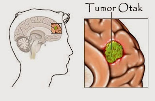 Mengidentifikasi Pembentukan Tumor Otak